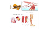 تصلب شرائین و درمان آن با گیاهان دارویی